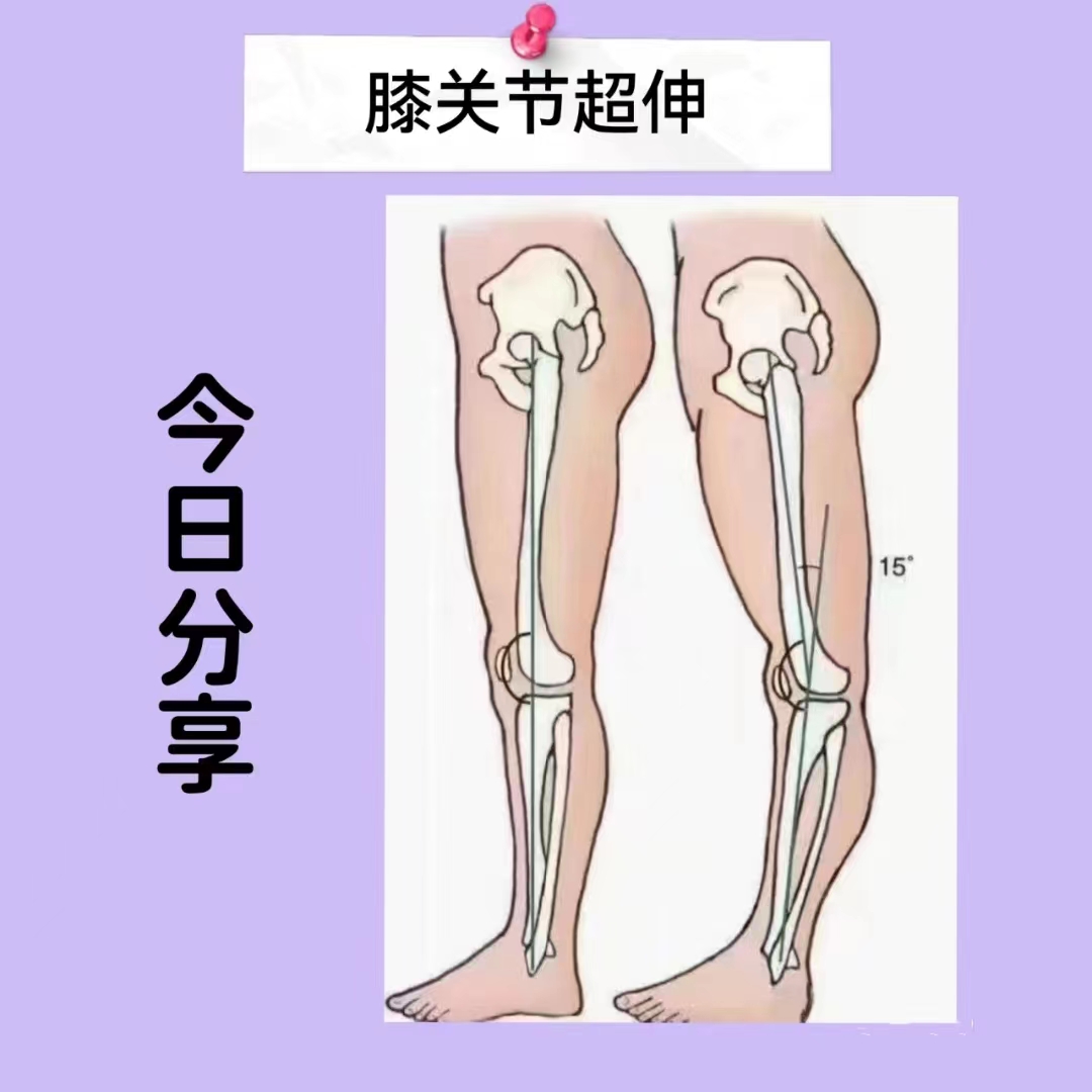 膝关节超伸有什么危害？